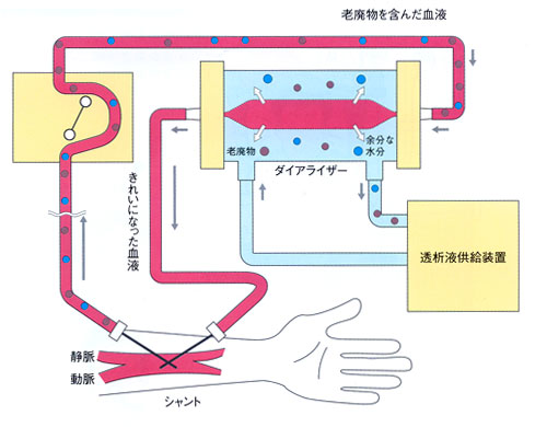 血液透析の仕組み